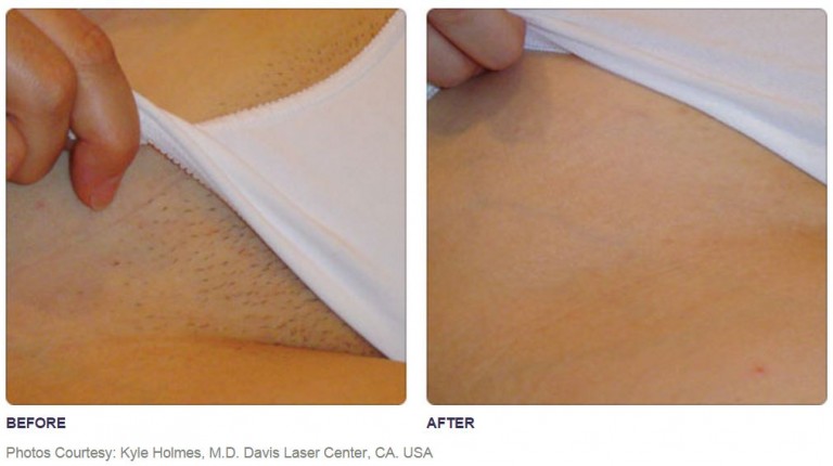 soprano-before-and-after-7